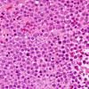 3B3 Plasma cell neoplasm (Case 3) H&E 3.jpg