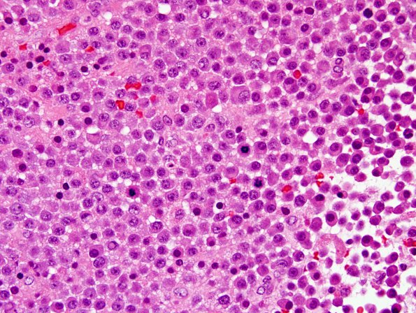 3B3 Plasma cell neoplasm (Case 3) H&E 3.jpg