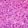 3B4 Plasma cell neoplasm (Case 3) H&E 100X 1.jpg