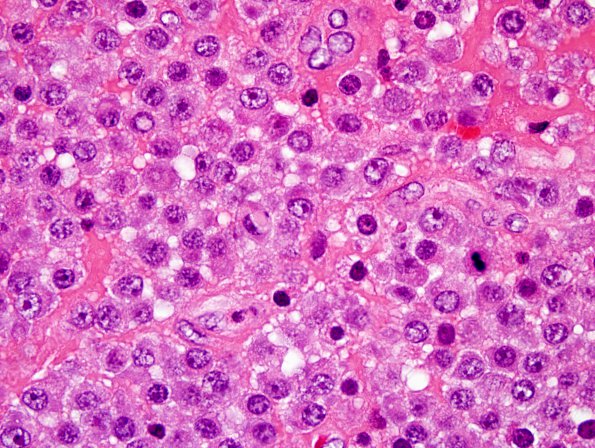 3B4 Plasma cell neoplasm (Case 3) H&E 100X 1.jpg