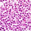 3B5 Plasma cell neoplasm (Case 3) H&E 100X 2.jpg