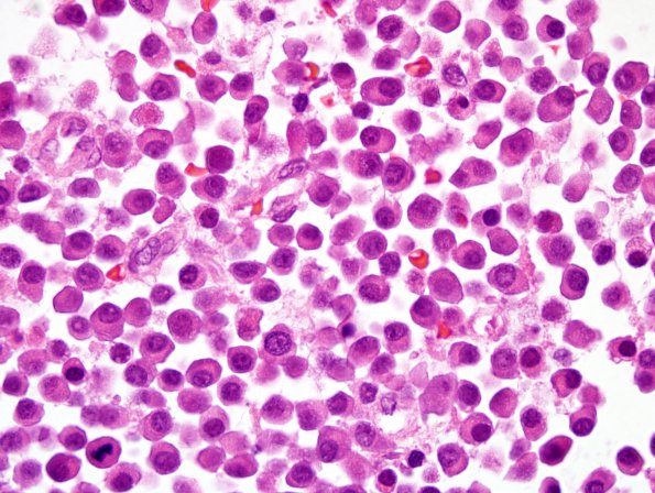 3B5 Plasma cell neoplasm (Case 3) H&E 100X 2.jpg