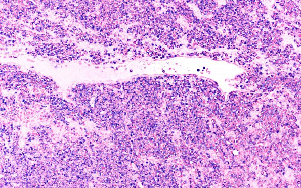 3D1 Plasma cell neoplasm (Case 3) Lambda 20X