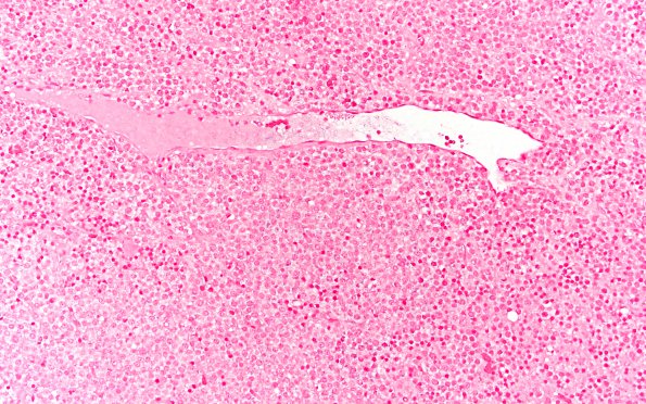 3D2 Plasma cell neoplasm (Case 3) Kappa 20X