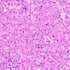 4B2 Plasma cell neoplasm (Case 4) H&E 1