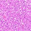 4B3 Plasma cell neoplasm (Case 4) H&E 40X 1