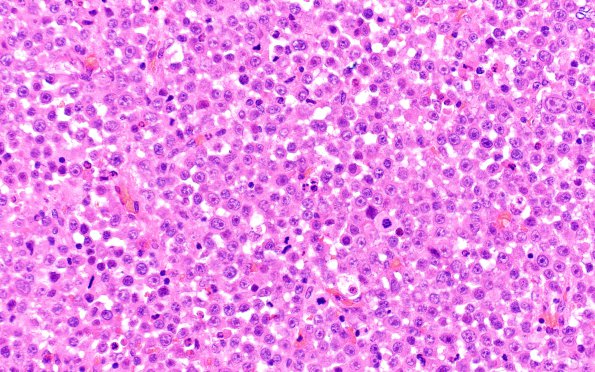 4B3 Plasma cell neoplasm (Case 4) H&E 40X 1