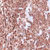 4C Plasma cell neoplasm (Case 4) CD138 2