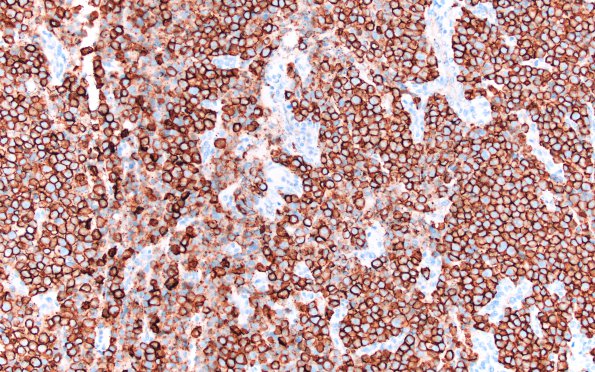 4C Plasma cell neoplasm (Case 4) CD138 2