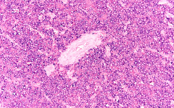 4E1 Plasma cell neoplasm (Case 4) Lambda 20X 1