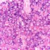 4E2 Plasma cell neoplasm (Case 4) Lambda 60X 1