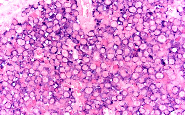 4E2 Plasma cell neoplasm (Case 4) Lambda 60X 1