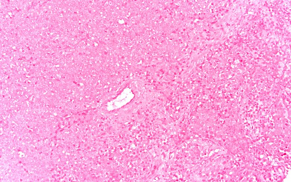 4E3 Plasma cell neoplasm (Case 4) Kappa 20X 1