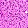 5A2 Plasma Cell Neoplasm (Case 5) H&E 60X