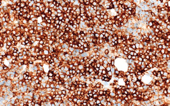 5B Plasma Cell Neoplasm (Case 5) CD138 40X