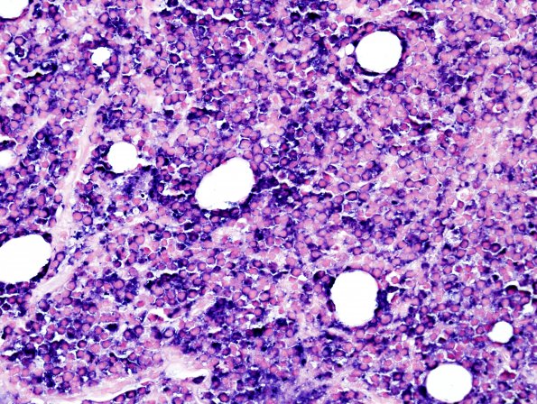 5C2 Plasma Cell Neoplasm (Case 5) ISH Lambda 1.jpg