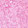 5C4 Plasma Cell Neoplasm (Case 5) ISH Kappa 1.jpg