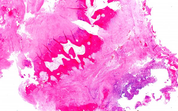 6A1 Plasma Cell Dyscrasia (Case 6) H&E 2X