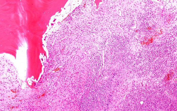 6A2 Plasma Cell Dyscrasia (Case 6) H&E 102X