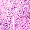 6A3 Plasma Cell Dyscrasia (Case 6) H&E 10xX