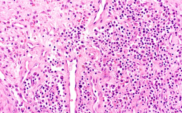 6A3 Plasma Cell Dyscrasia (Case 6) H&E 10xX