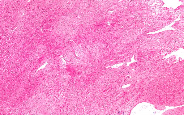 6C2 Plasma Cell Dyscrasia (Case 6) ISH Lambda