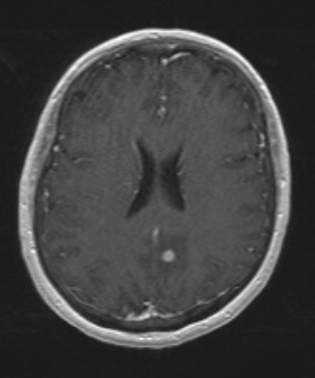 7A Plasma cell neoplasia (Case 7) T1W - Copy