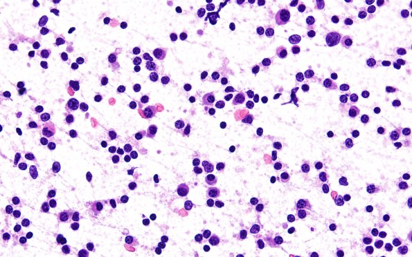 7B1 Plasma cell neoplasia (Case 7) Smear H&E 60X