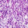 7B2 Plasma cell neoplasia (Case 7) H&E smear 2.jpg