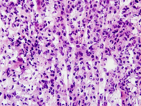 7B2 Plasma cell neoplasia (Case 7) H&E smear 2.jpg