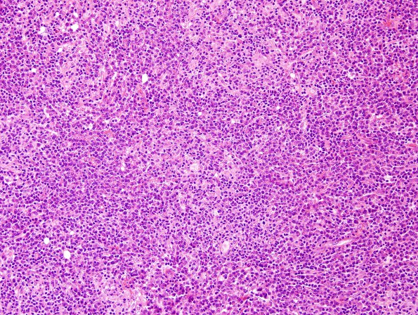 7C1 Plasma cell neoplasia (Case 7) H&E 10.jpg