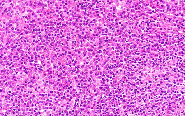 7C2 Plasma cell neoplasia (Case 7) H&E 40X