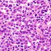 7C3 Plasma cell neoplasia (Case 7) H&E 6.jpg