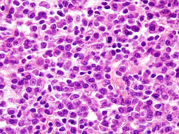 7C3 Plasma cell neoplasia (Case 7) H&E 6.jpg