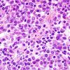 7C4 Plasma cell neoplasia (Case 7) ISH Kappa 10X.jpg