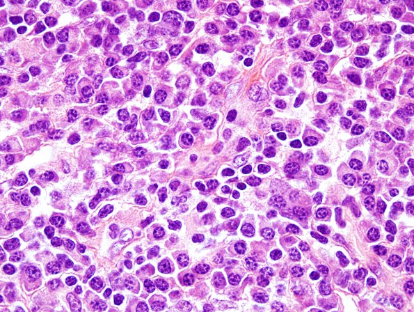 7C4 Plasma cell neoplasia (Case 7) ISH Kappa 10X.jpg