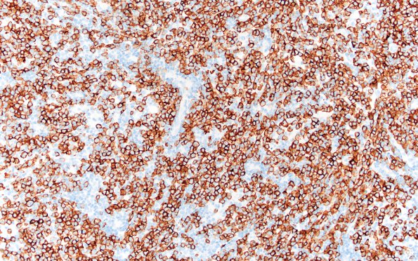 7D Plasma cell neoplasia (Case 7) CD138 20X