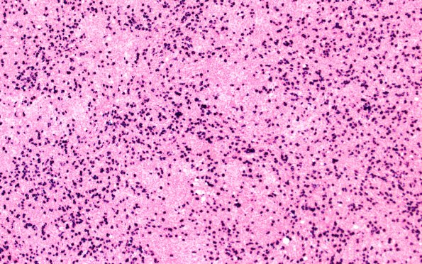 7G2 Plasma cell neoplasia (Case 7) ISH Lambda 10X