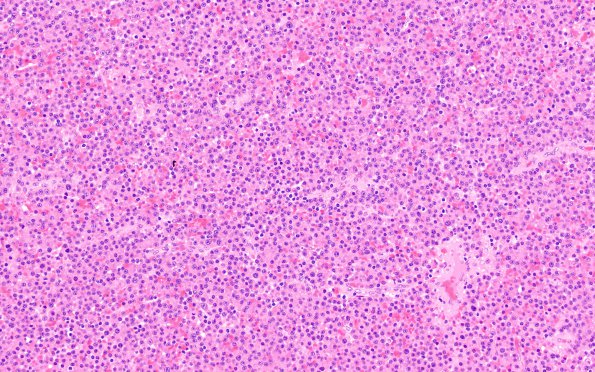 8A1 Plasma Cell Neoplasm (Case 8) H&E 2