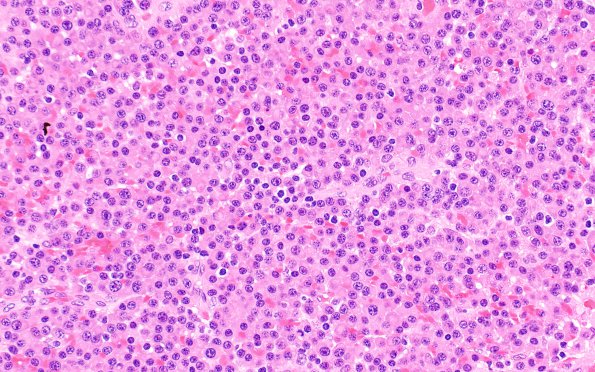 8A2 Plasma Cell Neoplasm (Case 8) H&E 1