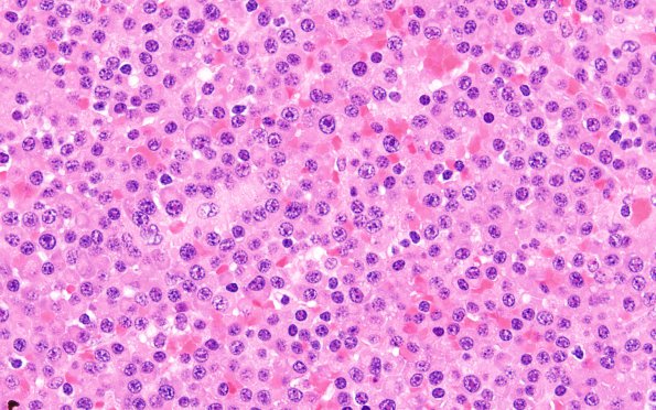 8A3 Plasma Cell Neoplasm (Case 8) H&E 3