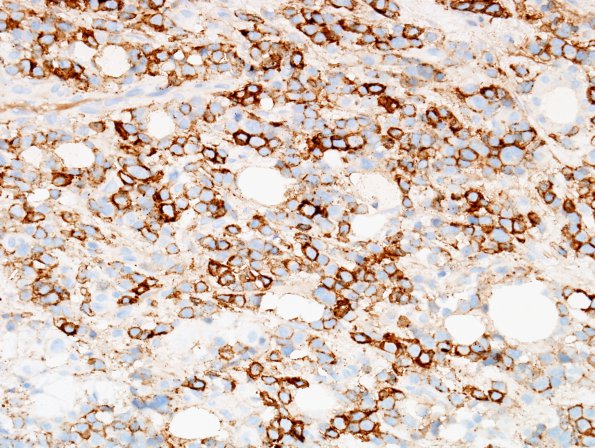 8B Plasma Cell Neoplasm (Case 8) CD138 2