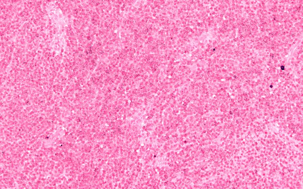 8D Plasma Cell Neoplasm (Case 8) ISH Lambda