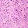 9B1 Plasma Cell Neoplasm (Case 9) H&E 1