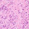 9B2 Plasma Cell Neoplasm (Case 9) H&E 2