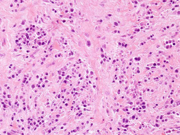 9B2 Plasma Cell Neoplasm (Case 9) H&E 2