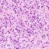 9B3 Plasma Cell Neoplasm (Case 9) H&E 3