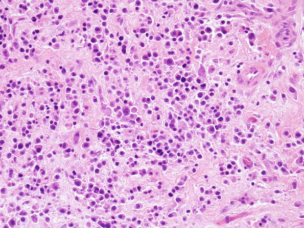 9B3 Plasma Cell Neoplasm (Case 9) H&E 3