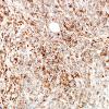 9C Plasma Cell Neoplasm (Case 9) CD138 3