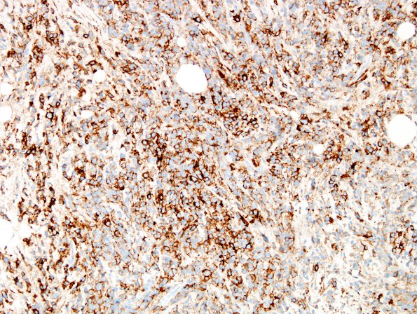 9C Plasma Cell Neoplasm (Case 9) CD138 3